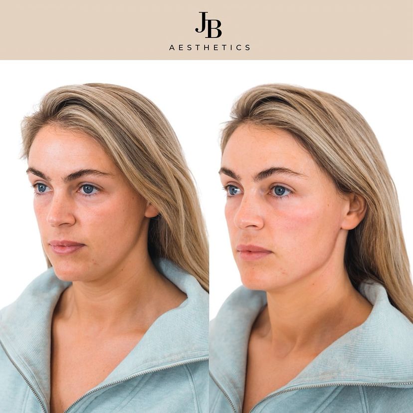 Woman with cheek filler, jawline filler and chin filler
