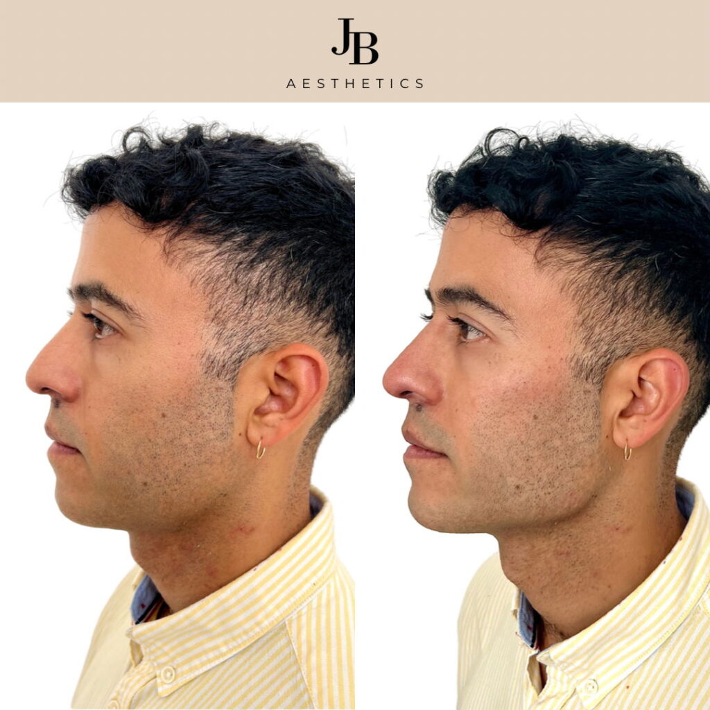 Man with cheek filler, jawline filler and chin filler