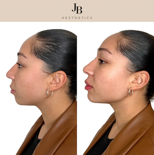 Woman with jawline filler and chin filler